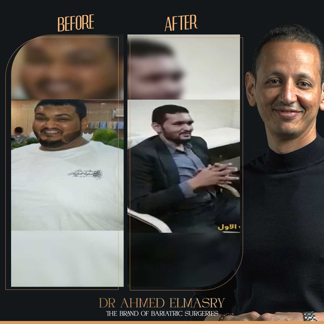 قصة نجاح مازن مع عمليات السمنة إنسان أخر خرج منى